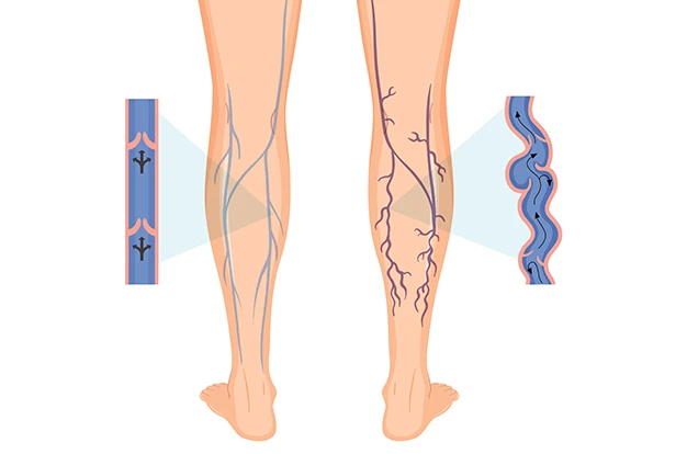 Foto mostra uma ilustração de pernas com varizes tortuosas e normais
